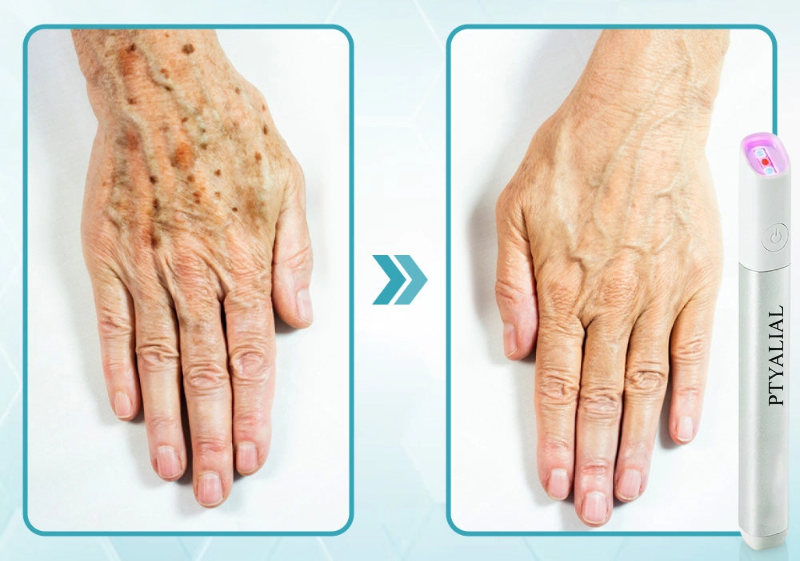 ✨Ptyalial™ All-in-One CO₂ Laser Eraser Pen | Removes Moles, Warts, Skin Flaws & Pigmentation