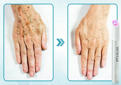 ✨Ptyalial™ All-in-One CO₂ Laser Eraser Pen | Removes Moles, Warts, Skin Flaws & Pigmentation