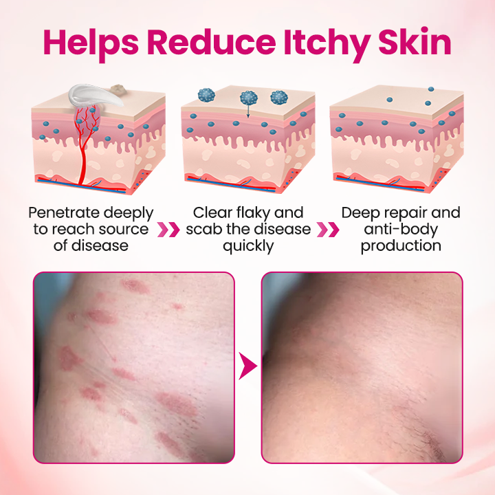 🏆 Breakthrough in Women's Intimate Health! Feel Relief in Just 3 Days with Multi-Targeted HPV Defense