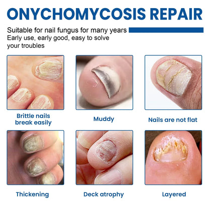 Acezozla® Fungus Nail Repair Patches